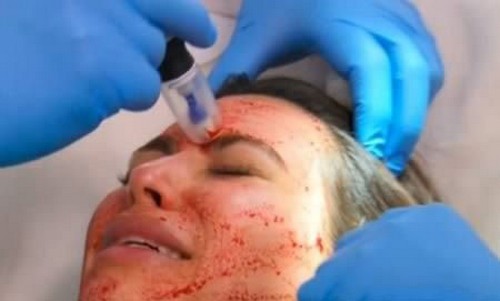 113-1 روش صورت خون آشام