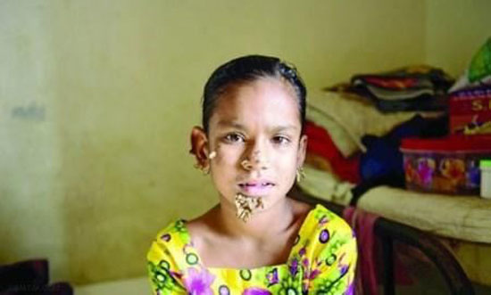 دختری که روی صورتش شاخ و برگ درخت رشد می کند + عکس دختری که روی صورتش شاخ و برگ درخت رشد می کند + عکس