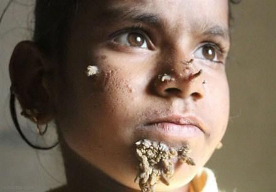 دختری که روی صورتش شاخ و برگ درخت رشد می کند + عکس دختری که روی صورتش شاخ و برگ درخت رشد می کند + عکس