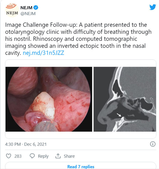 دندان سرکش، سر از دماغ مرد 38 ساله درآورد + عکس دندان سرکش، سر از دماغ مرد 38 ساله درآورد + عکس