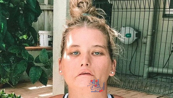 168372382397477-irannaz-com تایلا - Tayla یکی از افراد نادر در دنیا با یک اختلال نادر ، دختری که نمی توانست بخندد، سوپر مدل شد