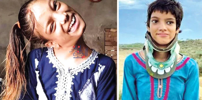 173235295296428-irannaz-com دختری عجیب و ترسناک که گردنش 90 درجه چرخیده!!