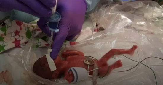 نوزادی به اندازه سیب رکورد گینس را شکست (عکس) نوزادی به اندازه سیب رکورد گینس را شکست (عکس)