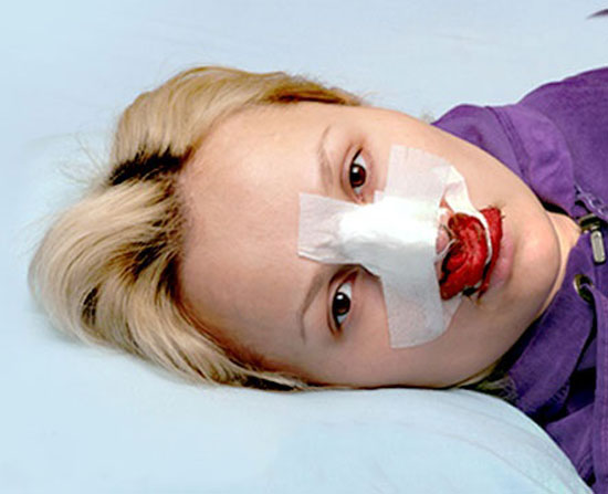 خبر جدید | اتفاق وحشتناکی که بعد از عمل بینی برای این زن رخ داد + عکس خبر جدید | اتفاق وحشتناکی که بعد از عمل بینی برای این زن رخ داد + عکس