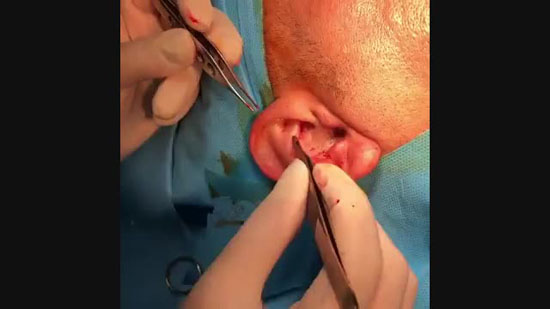 اتفاق وحشتناکی که بعد از عمل بینی برای این زن رخ داد + عکس اتفاق وحشتناکی که بعد از عمل بینی برای این زن رخ داد + عکس