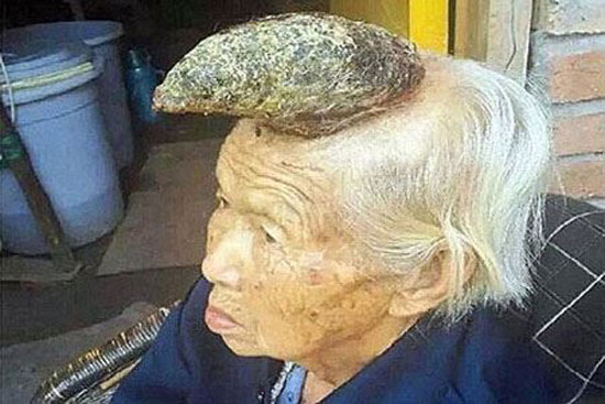 پیرزنی که روی سرش شاخ شبیه گوزن رشد کرده است + عکس پیرزنی که روی سرش شاخ شبیه گوزن رشد کرده است + عکس