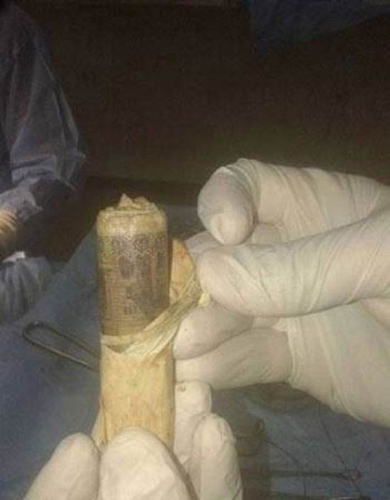 کشف 1000 پوند پول نقد در شکم پاره شده بیمار + عکس کشف 1000 پوند پول نقد در شکم پاره شده بیمار + عکس