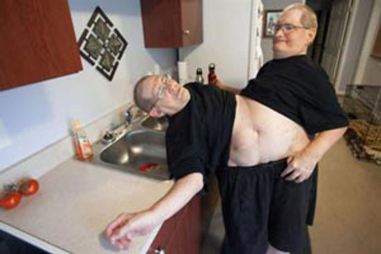 مردان دوقلو 63 ساله با یک بدن و 2 سر + عکس 18+ مردان دوقلو 63 ساله با یک بدن و 2 سر + عکس 18+