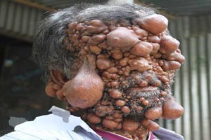 تاریخ و زمان وبگردی؛ مردی با بیماری عجیب هزاران حباب شبیه بیضه روی بدنش + عکس 18+ تاریخ و زمان وبگردی؛ مردی با بیماری عجیب هزاران حباب شبیه بیضه روی بدنش + عکس 18+