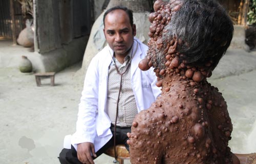 مردی با بیماری عجیب هزاران حباب شبیه بیضه روی بدنش + عکس 18+ مردی با بیماری عجیب هزاران حباب شبیه بیضه روی بدنش + عکس 18+