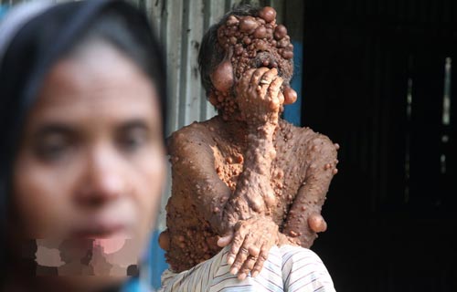 مردی با بیماری عجیب هزاران حباب شبیه بیضه روی بدنش + عکس 18+ مردی با بیماری عجیب هزاران حباب شبیه بیضه روی بدنش + عکس 18+