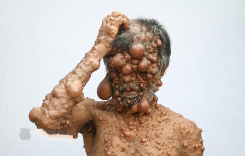 مردی با بیماری عجیب هزاران حباب شبیه بیضه روی بدنش + عکس 18+ مردی با بیماری عجیب هزاران حباب شبیه بیضه روی بدنش + عکس 18+