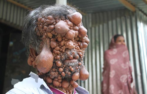 مردی با بیماری عجیب هزاران حباب شبیه بیضه روی بدنش + عکس 18+ مردی با بیماری عجیب هزاران حباب شبیه بیضه روی بدنش + عکس 18+