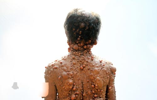 مردی با بیماری عجیب هزاران حباب شبیه بیضه روی بدنش + عکس 18+ مردی با بیماری عجیب هزاران حباب شبیه بیضه روی بدنش + عکس 18+