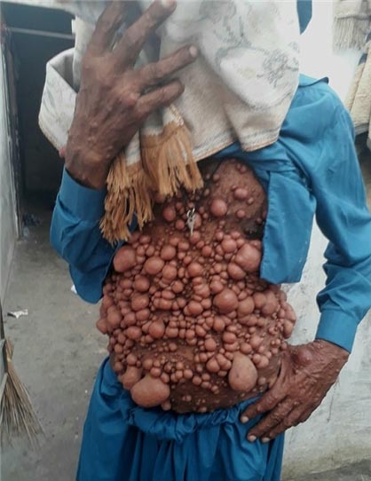 مردی با بیماری عجیب هزاران حباب شبیه بیضه روی بدنش + عکس 18+ مردی با بیماری عجیب هزاران حباب شبیه بیضه روی بدنش + عکس 18+