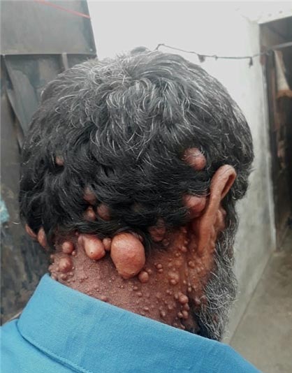 مردی با بیماری عجیب هزاران حباب شبیه بیضه روی بدنش + عکس 18+ مردی با بیماری عجیب هزاران حباب شبیه بیضه روی بدنش + عکس 18+