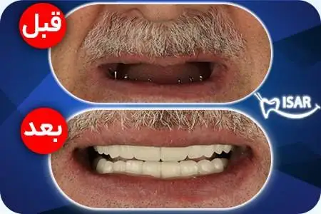 عکس  -  سعید معروف تغییر چهره داد   -   جادوگر والیبال قابل شناسایی نیست